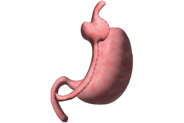 Gastric Bypass