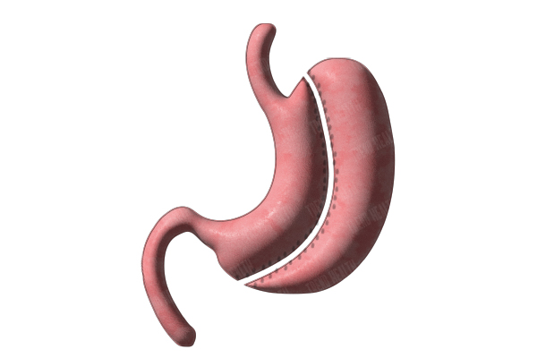 Sleeve Gastrectomy