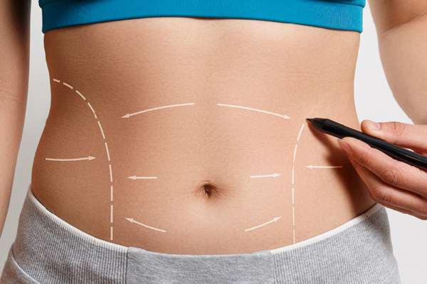 Abdominoplastika